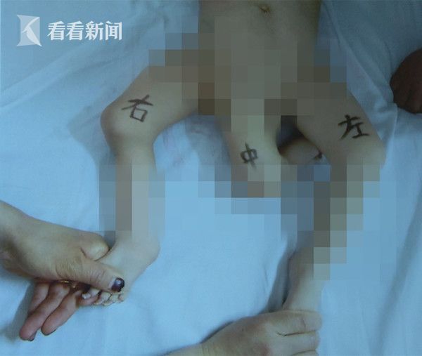 上海公卫中心成功为一三条腿男婴实施手术