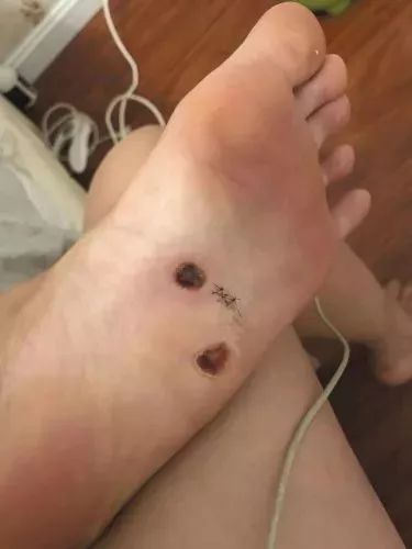 可怕!姑娘泰国蜜月回来,脚底出现弯曲红线,还会动……医生也惊呆了