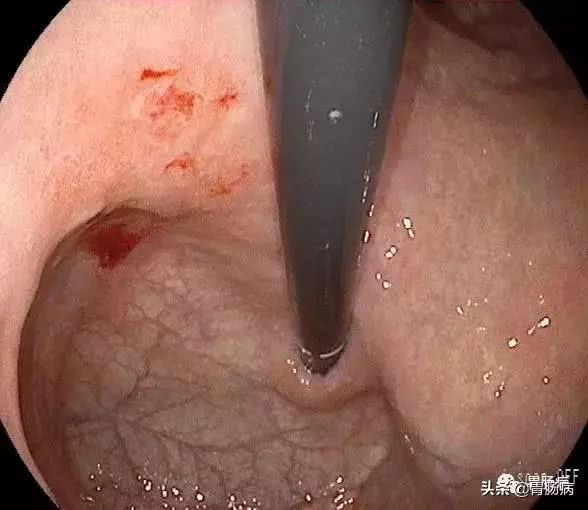 第1处,贲门 电儿子染倒腾镜不清雅察