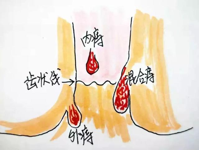 百家号_侬好上海    俗话说"十男九痔,十女十痔",有相关调查显示,痔疮