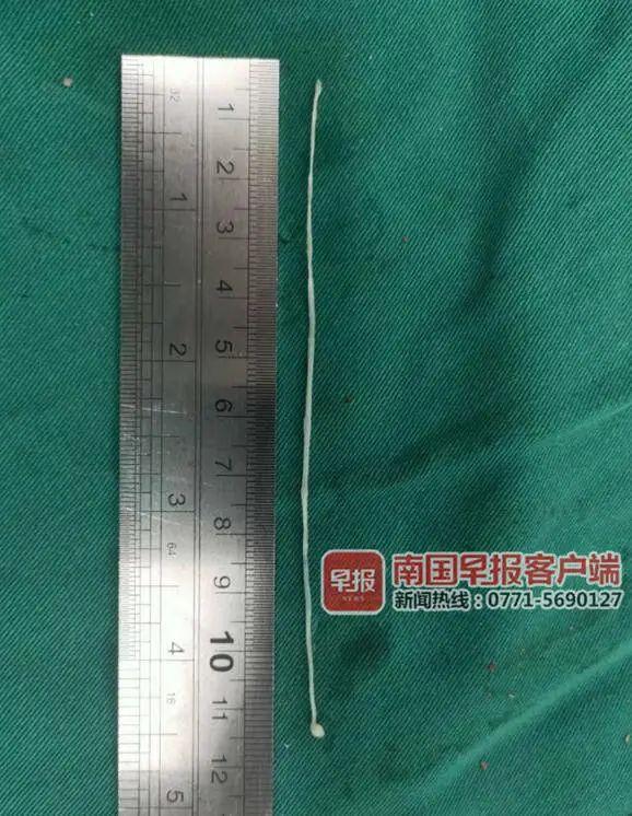 百色一男子脑袋长了条11厘米长的虫!医生取出时它还在动!